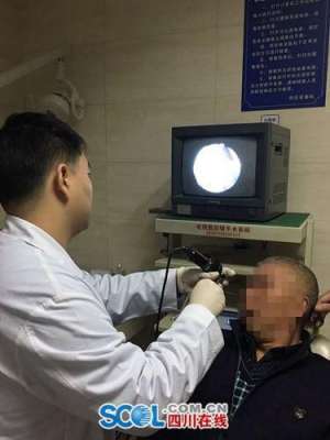 男子鼻腔取出5厘米長螞蟥 專家：野外慎飲山泉水