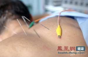 針灸在多國獲合法地位 納醫保體系