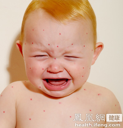 北京已進入麻疹高發季節