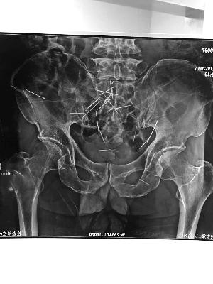 老人腹中現22根繡花針或已存幾十年 家人報警