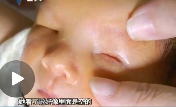 罕見！廣州一女子生出無眼男嬰(圖)