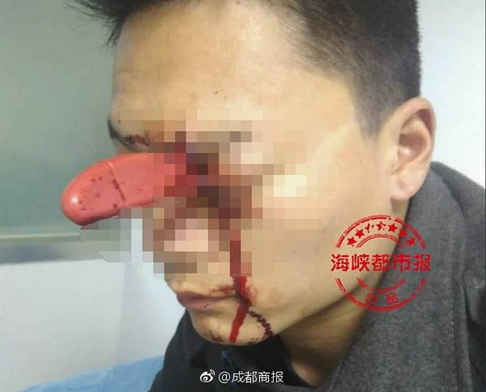 眼插水果刀就診 和老婆起爭執不小心插進腦袋