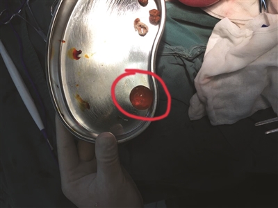 1歲男童誤食水寶寶嚴(yán)重脫水 取出時大如乒乓球