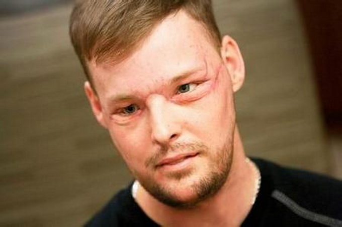 美國男子吞槍毀臉 成功移植新臉第二次生命會更加珍惜