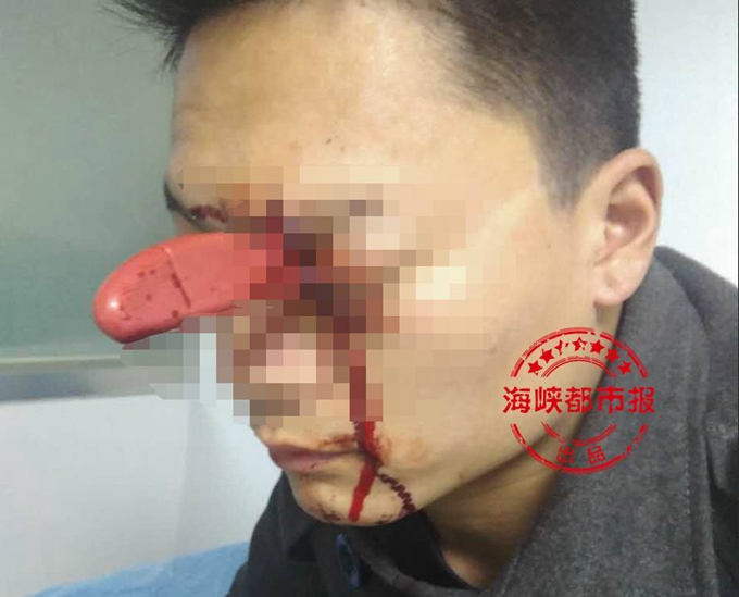 男子頭插水果刀淡定排隊就診 網友：厲害了我的哥