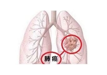 北京市新發惡性腫瘤中肺癌約占20%