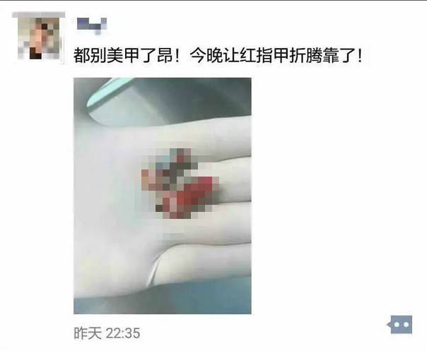 19歲女孩兩節手指被瞬間拽斷！ 罪魁禍首竟是美甲