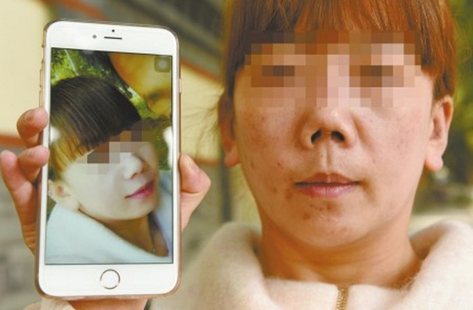 女子被整成朝天鼻 整容變毀容當場便失控地號啕起來