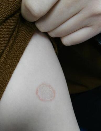 每日與貓“同床共枕” 女子身上長出圓形斑塊