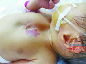 男嬰天生玻璃心 皮膚薄得像一層紙能清晰看見心臟跳動