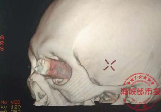 眼插水果刀就診 和老婆起爭執不小心插進腦袋