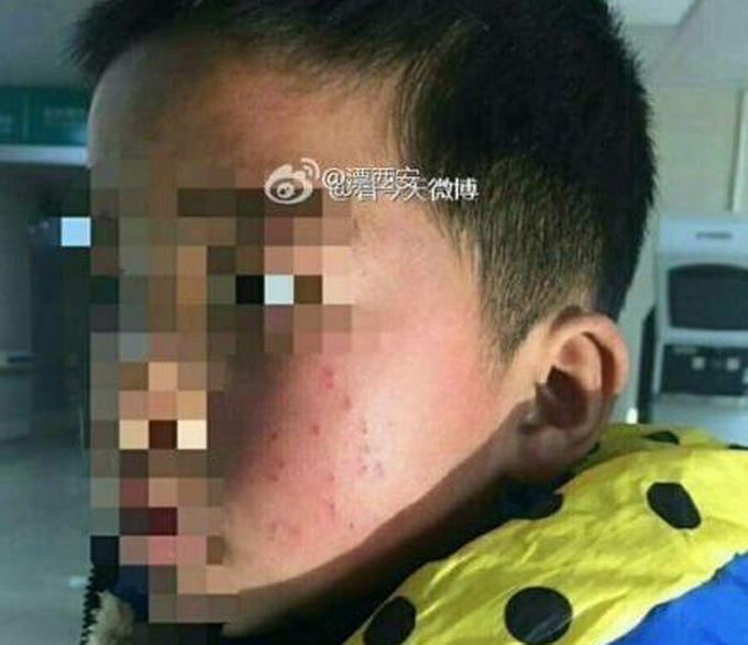 小學校長筆扎學生 孩子左臉被捅17個眼令人憤怒