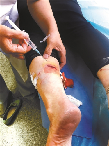 無(wú)主狗四處流竄咬傷多名路人 最嚴(yán)重者腿被咬一窟窿