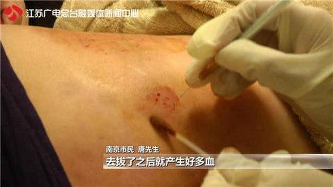 放血排毒疼到報警 “穴位”上被扎二十多針立刻血流如注