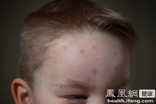 叫停首付貸 護(hù)理水痘別用激素