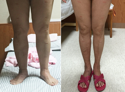 清華長庚康復醫學科：淋巴水腫病友會正式成立