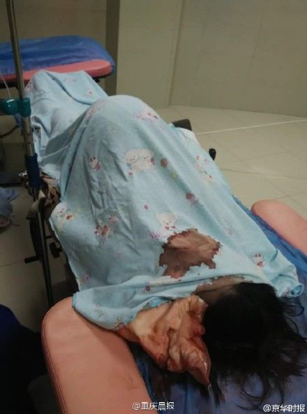 孕婦打無痛分娩針后口吐白沫死亡
