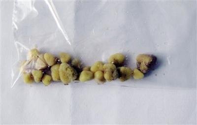 覺得手術可怕男子每天灌10瓶啤酒想要化掉腎結石
