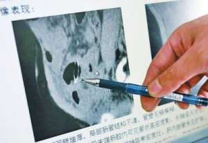 粗心媽媽將10厘米長縫衣針扎進孩子體內