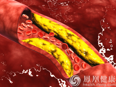 溶栓治療或可降低血栓復發幾率